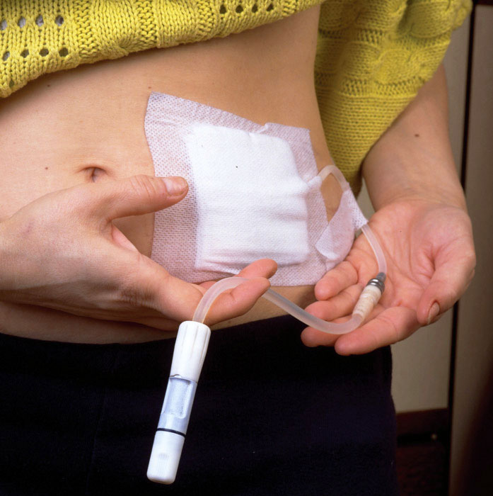 ฝังสายยางล้างไต ในช่องท้อง